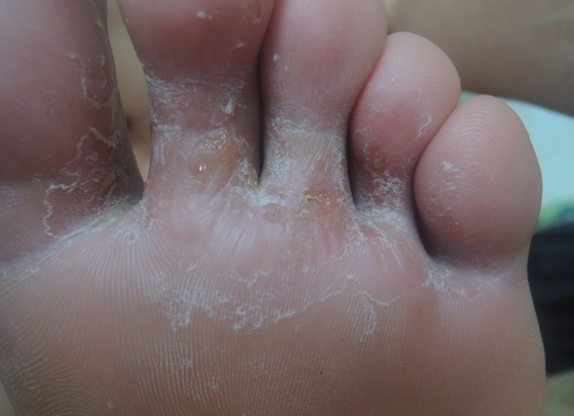 湿性脚气病的症状图片图片
