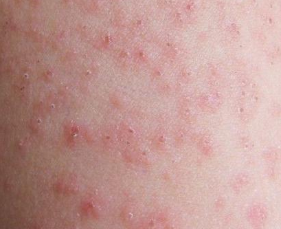胆碱能性荨麻疹克星图片