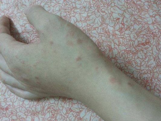 皮肤湿毒症状图片37
