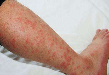 胆碱性荨麻疹 (6)