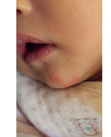 宝宝口腔透明水泡图片图片