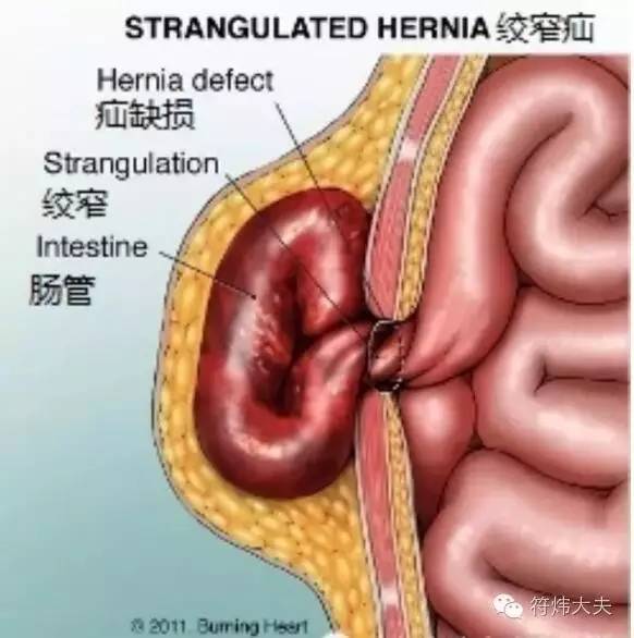 腹股沟疝病人能够旅游吗?
