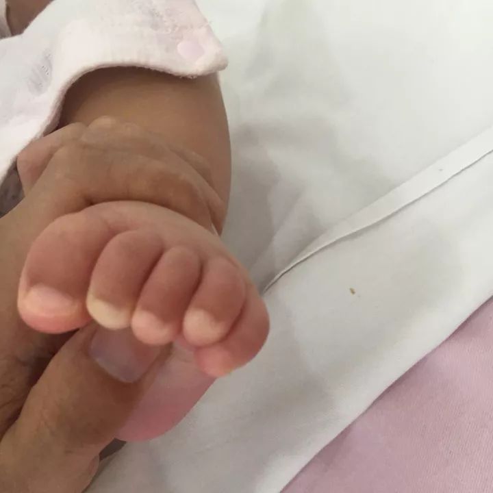 宝宝足抓握反应会不会是脑瘫?