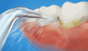 冲牙器会不会牙龈萎缩