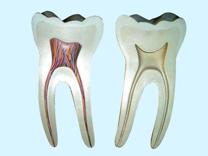 牙髓炎图片 (2)
