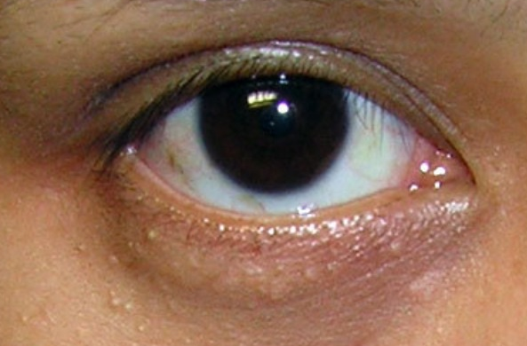 汗管瘤图片眼部图片 (34)