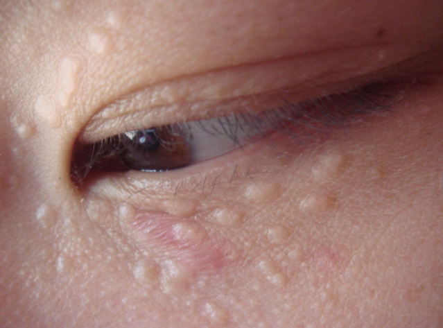 女性眼部汗管瘤图片图片
