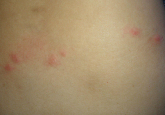 大人风疹的症状图片 (25)