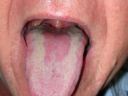 舌苔厚白图片 (49)