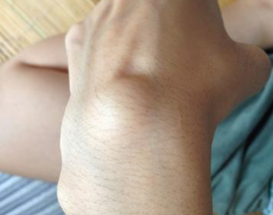 手腕腱鞘囊肿图片 (40)