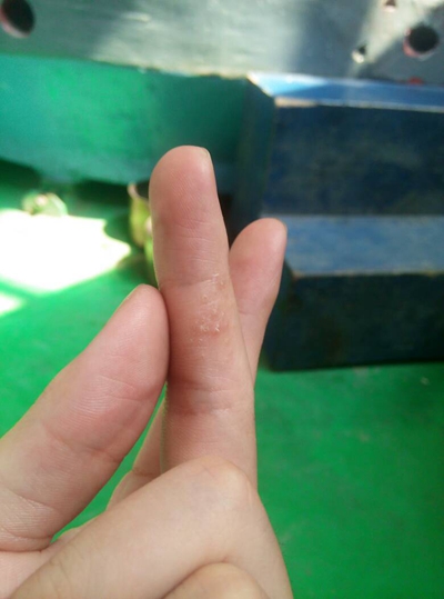 手指水泡型湿疹图片 (14)
