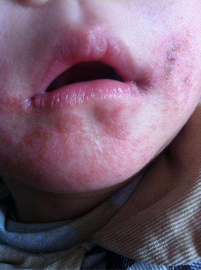 口周湿疹初期图片