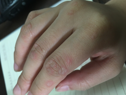 手指水泡型湿疹图片9