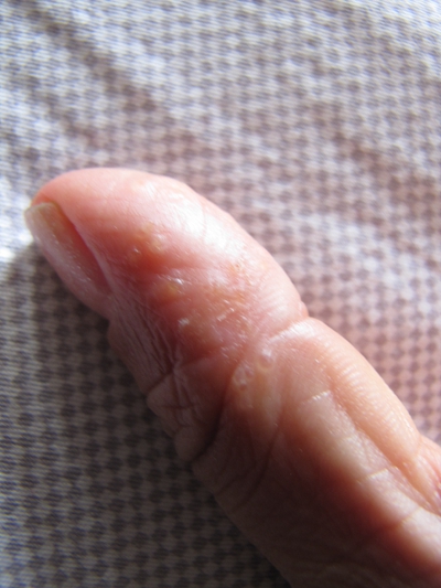 手指角质化湿疹图片