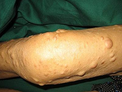 脂肪瘤前期症状图片图片