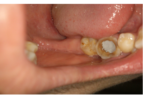 牙髓炎图片 (4)