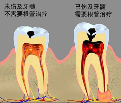 牙髓炎图片 (8)