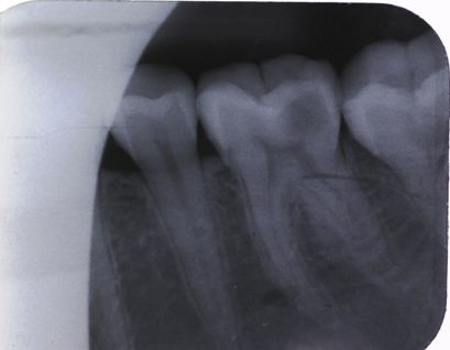 牙髓炎图片 (15)
