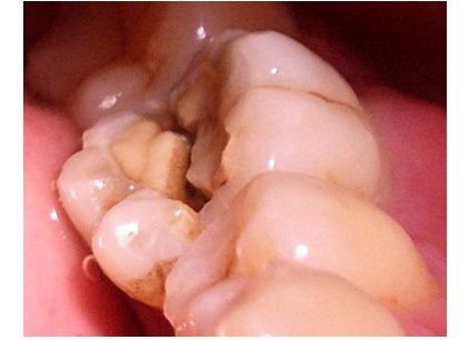 牙髓炎图片 (1)