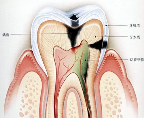 牙髓炎图片 (37)