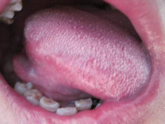 口腔念珠菌感染 (41)