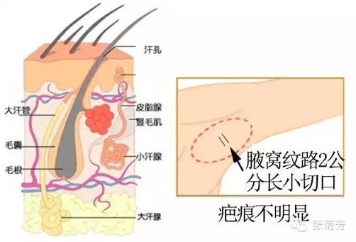 家族遗传狐臭什么原理_狐臭腋下有什么特征图(2)
