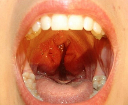 正常喉咙和发炎喉咙图片