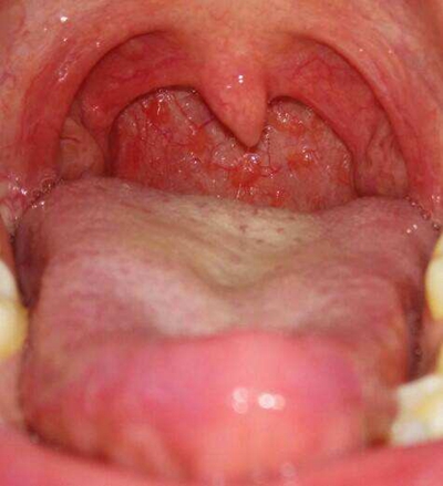 喉咙正常图片和发炎图片