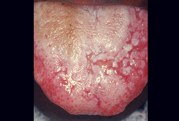 口咽癌 (41)