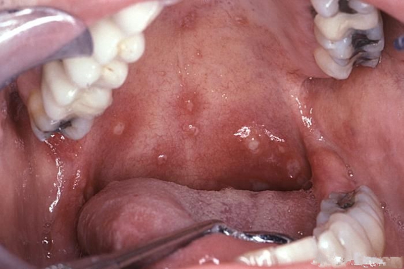 口腔疱疹初期图片