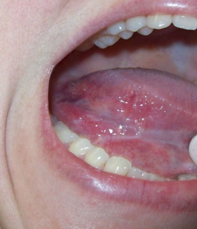 口咽癌 (2)