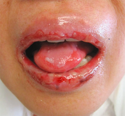 口咽癌 (5)