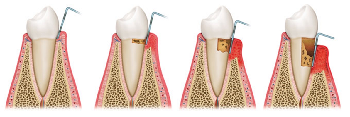牙龈囊肿图片 (3)