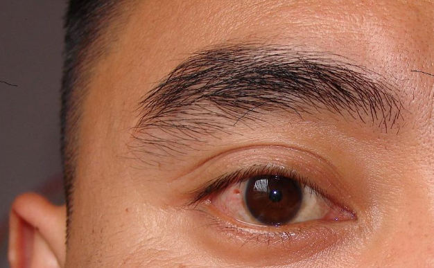 眼结膜炎症状图片 (57)
