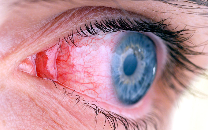 眼结膜炎症状图片 (8)
