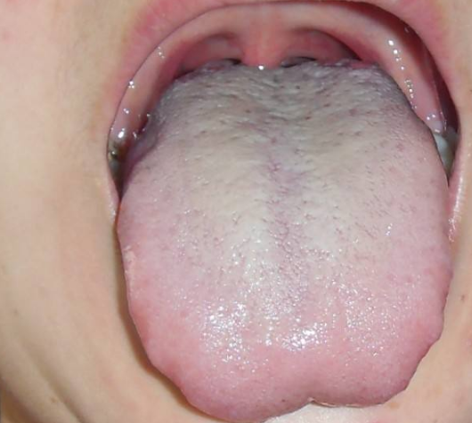 胃火旺的舌头图片图片