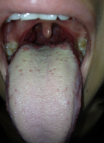 口舌炎的症状图片图片