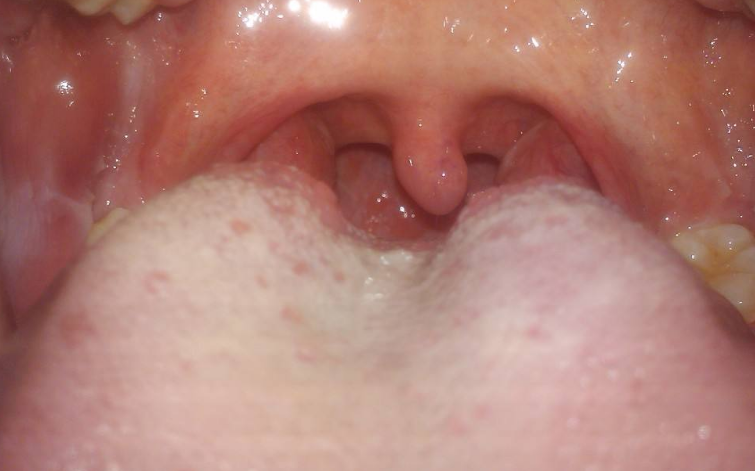 胃炎的症状舌头图片 (57)