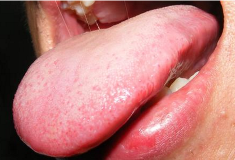胃炎的症状舌头图片 (54)