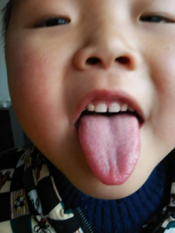 胃炎的症状舌头图片 (6)