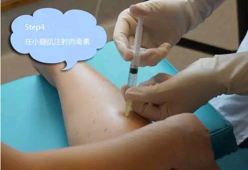 肉毒素瘦腿针的特点有哪些?