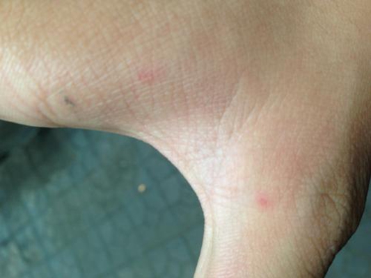 医師は梅毒をどのように診断しますか?