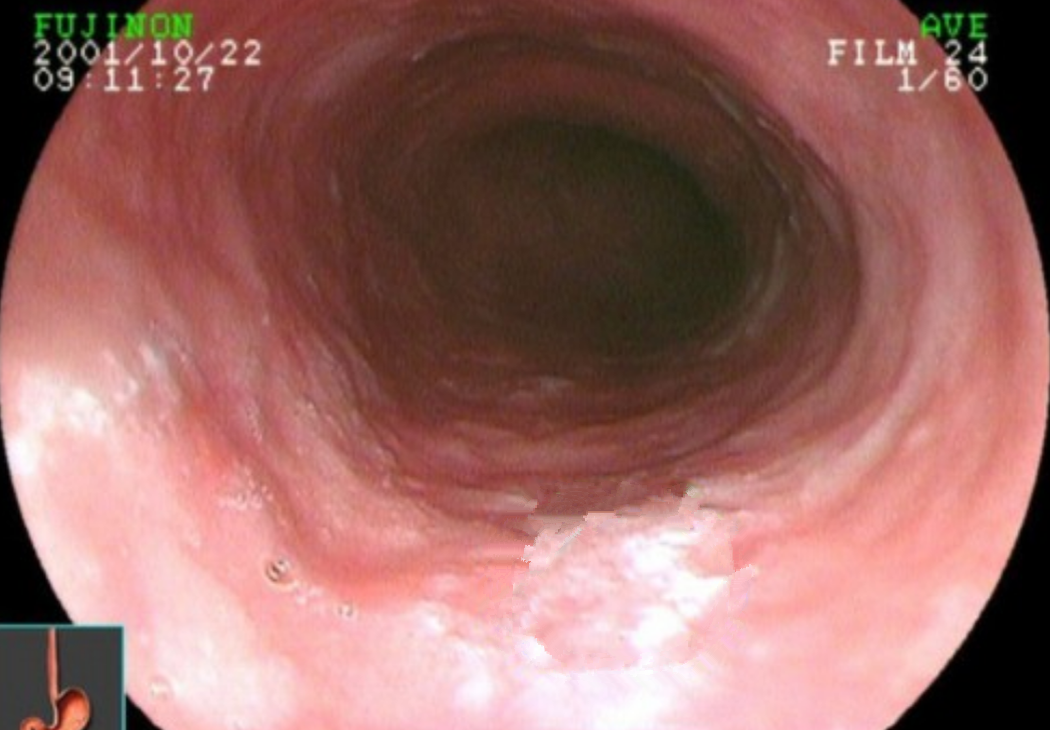 食管癌早期症状