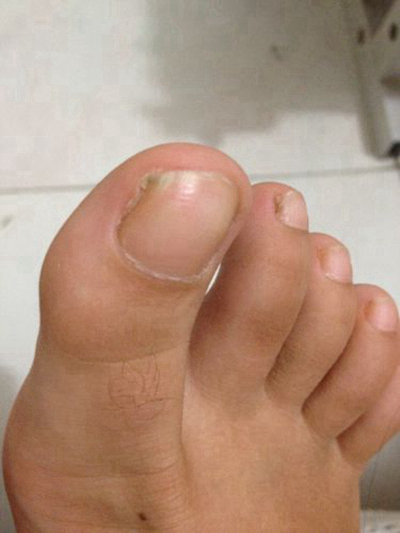 灰指甲初期症状早期图片