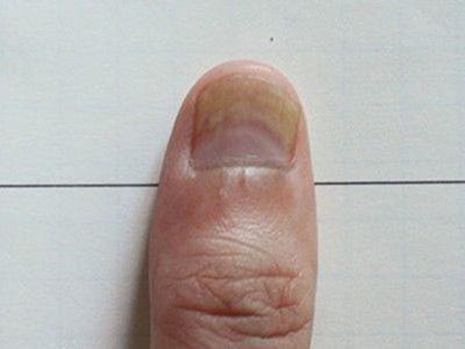灰指甲的初期症状类别图片