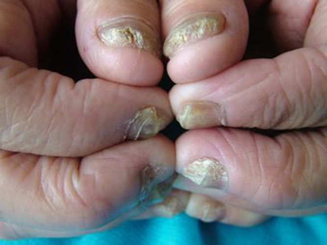 灰指甲的初期症状有哪些图片