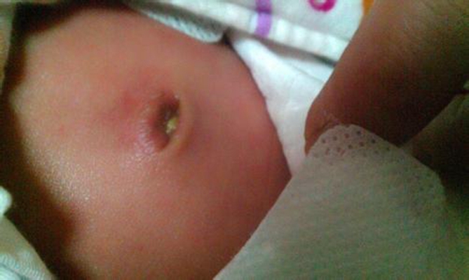 婴儿脐疝图片 (45)