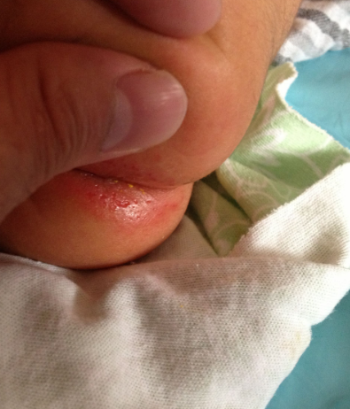 11个月宝宝长痔疮图片图片