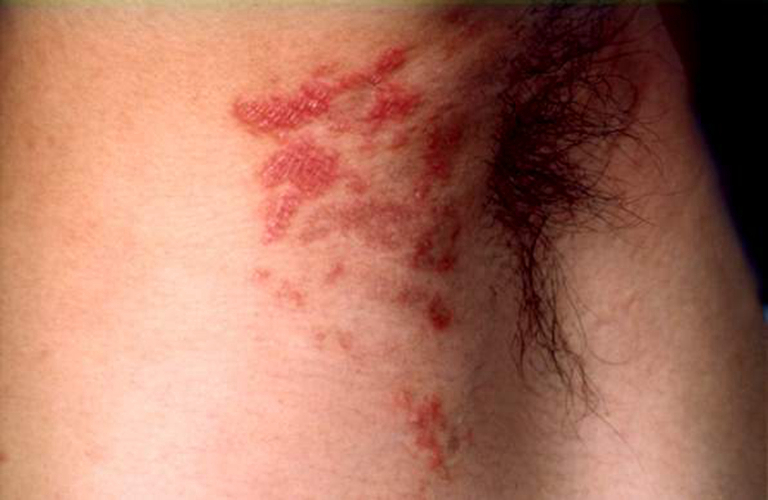 女性梅毒早期症状图片图片
