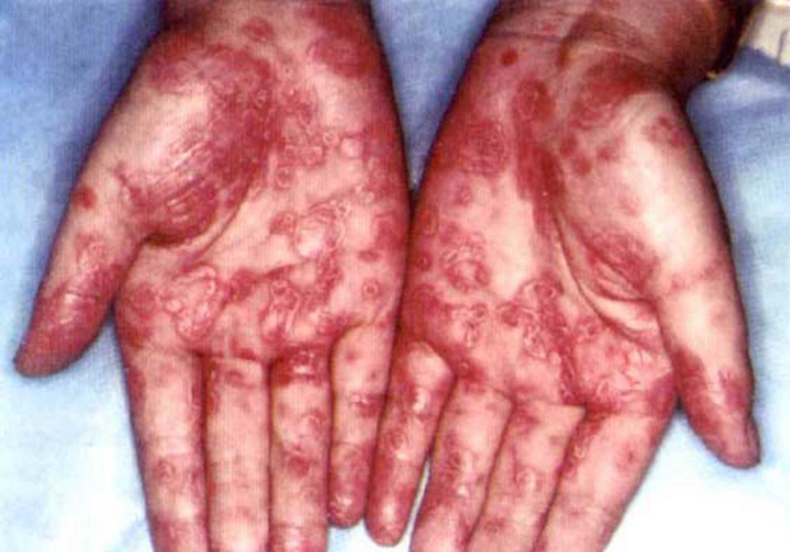 梅毒感染身上长红疙瘩图片